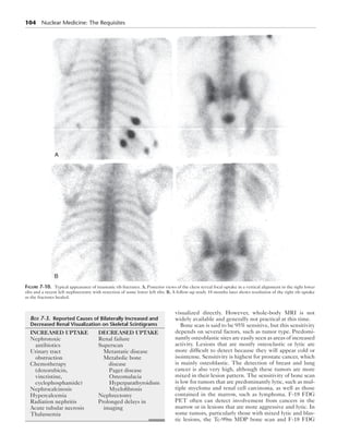 104 Nuclear Medicine: The Requisites 
visualized directly. However, whole-body MRI is not 
widely available and generally not practical at this time. 
Bone scan is said to be 95% sensitive, but this sensitivity 
depends on several factors, such as tumor type. Predomi-nantly 
osteoblastic sites are easily seen as areas of increased 
activity. Lesions that are mostly osteoclastic or lytic are 
more difficult to detect because they will appear cold or 
isointense. Sensitivity is highest for prostate cancer, which 
is mainly osteoblastic. The detection of breast and lung 
cancer is also very high, although these tumors are more 
mixed in their lesion pattern. The sensitivity of bone scan 
is low for tumors that are predominantly lytic, such as mul-tiple 
myeloma and renal cell carcinoma, as well as those 
contained in the marrow, such as lymphoma. F-18 FDG 
PET often can detect involvement from cancers in the 
marrow or in lesions that are more aggressive and lytic. In 
some tumors, particularly those with mixed lytic and blas-tic 
lesions, the Tc-99m MDP bone scan and F-18 FDG 
A 
B 
Figure 7-10. Typical appearance of traumatic rib fractures. A, Posterior views of the chest reveal focal uptake in a vertical alignment in the right lower 
ribs and a recent left nephrectomy with resection of some lower left ribs. B, A follow-up study 18 months later shows resolution of the right rib uptake 
as the fractures healed. 
Box 7-3. Reported Causes of Bilaterally Increased and 
Decreased Renal Visualization on Skeletal Scintigrams 
INCREASED UPTAKE 
Nephrotoxic 
antibiotics 
Urinary tract 
obstruction 
Chemotherapy 
(doxorubicin, 
vincristine, 
cyclophosphamide) 
Nephrocalcinosis 
Hypercalcemia 
Radiation nephritis 
Acute tubular necrosis 
Thalassemia 
DECREASED UPTAKE 
Renal failure 
Superscan 
Metastatic disease 
Metabolic bone 
disease 
Paget disease 
Osteomalacia 
Hyperparathyroidism 
Myelofibrosis 
Nephrectomy 
Prolonged delays in 
imaging 
 