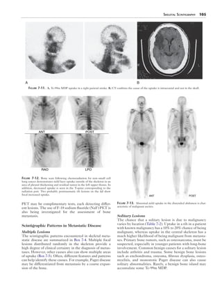 Skeletal Scintigraphy 105 
A B 
Figure 7-11. A, Tc-99m MDP uptake in a right parietal stroke. B, CT confirms the cause of the uptake is intracranial and not in the skull. 
PET may be complimentary tests, each detecting differ-ent 
lesions. The use of F-18 sodium fluoride (NaF) PET is 
also being investigated for the assessment of bone 
metastasis. 
Scintigraphic Patterns in Metastatic Disease 
Multiple Lesions 
The scintigraphic patterns encountered in skeletal meta-static 
disease are summarized in Box 7-4. Multiple focal 
lesions distributed randomly in the skeleton provide a 
high degree of clinical certainty in the diagnosis of metas-tases. 
However, other causes also can show multiple areas 
of uptake (Box 7-5). Often, different features and patterns 
can help identify these causes. For example, Paget disease 
may be differentiated from metastasis by a coarse expan-sion 
of the bone. 
Solitary Lesions 
The chance that a solitary lesion is due to malignancy 
varies by location (Table 7-2). Uptake in a rib in a patient 
with known malignancy has a 10% to 20% chance of being 
malignant, whereas uptake in the central skeleton has a 
much higher likelihood of being malignant from metasta-ses. 
Primary bone tumors, such as osteosarcoma, must be 
suspected, especially in younger patients with long-bone 
involvement. Common benign causes for a solitary lesion 
include arthritis and trauma. Some benign bone lesions 
such as enchondroma, osteoma, fibrous dysplasia, osteo-myelitis, 
and monostotic Paget disease can also cause 
solitary abnormalities. Rarely, a benign bone island may 
accumulate some Tc-99m MDP. 
Figure 7-12. Bone scan following chemoradiation for non–small cell 
lung cancer demonstrates mild hazy uptake outside of the skeleton in an 
area of pleural thickening and residual tumor in the left upper thorax. In 
addition, decreased uptake is seen in the T-spine corresponding to the 
radiation port. Two probably posttraumatic rib lesions on the left show 
focal increased uptake. 
Figure 7-13. Abnormal mild uptake in the distended abdomen is char-acteristic 
of malignant ascites. 
 