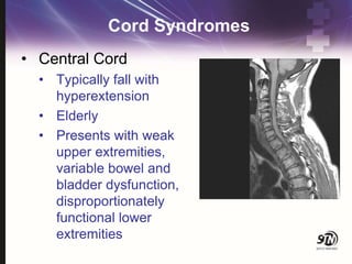 Cord Syndromes
• Central Cord
• Typically fall with
hyperextension
• Elderly
• Presents with weak
upper extremities,
variable bowel and
bladder dysfunction,
disproportionately
functional lower
extremities
 