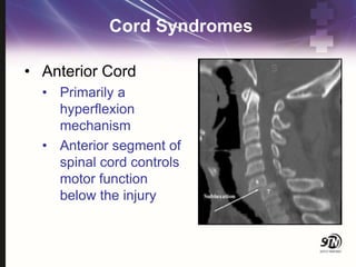 Cord Syndromes
• Anterior Cord
• Primarily a
hyperflexion
mechanism
• Anterior segment of
spinal cord controls
motor function
below the injury
 