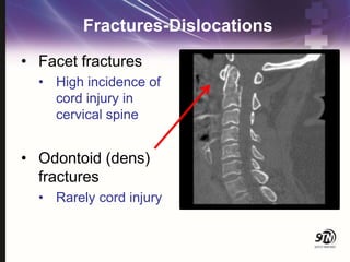 Fractures-Dislocations
• Facet fractures
• High incidence of
cord injury in
cervical spine
• Odontoid (dens)
fractures
• Rarely cord injury
 