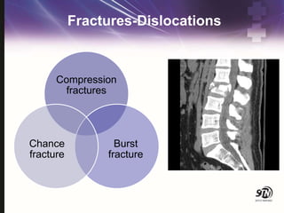 Fractures-Dislocations
Compression
fractures
Burst
fracture
Chance
fracture
 