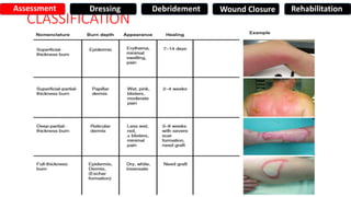 CLASSIFICATION
Assessment Dressing Debridement Wound Closure Rehabilitation
 