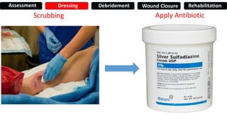 Scrubbing Apply Antibiotic
Assessment Dressing Debridement Wound Closure Rehabilitation
 