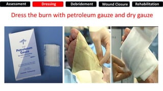 Dress the burn with petroleum gauze and dry gauze
Assessment Dressing Debridement Wound Closure Rehabilitation
 
