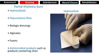 Partial thickness burn
• Hydrocolloids
• Polyurethane films
• Biologic dressings
• Alginates
• Foams
• Antimicrobial products such as
products containing silver.
Hydrocolloid
Assessment Dressing Debridement Wound Closure Rehabilitation
 