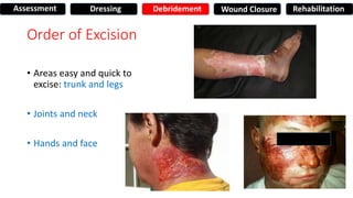 Order of Excision
• Areas easy and quick to
excise: trunk and legs
• Joints and neck
• Hands and face
Assessment Dressing Debridement Wound Closure Rehabilitation
 