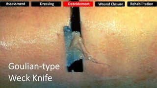Goulian-type
Weck Knife
Assessment Dressing Debridement Wound Closure Rehabilitation
 