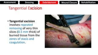 Tangential Excision
• Tangential excision
involves repeated
removing of very thin
slices (0.5 mm thick) of
burned tissue from the
zones of stasis and
coagulation.
Assessment Dressing Debridement Wound Closure Rehabilitation
 