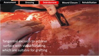 Tangential excision to achieve
surface with viable bleeding,
which are suitable for grafting
Assessment Dressing Debridement Wound Closure Rehabilitation
 