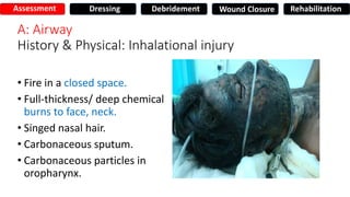 A: Airway
History & Physical: Inhalational injury
• Fire in a closed space.
• Full-thickness/ deep chemical
burns to face, neck.
• Singed nasal hair.
• Carbonaceous sputum.
• Carbonaceous particles in
oropharynx.
Assessment Dressing Debridement Wound Closure Rehabilitation
 