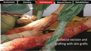 Epifascial excision and
grafting with skin grafts
Assessment Dressing Debridement Wound Closure Rehabilitation
 