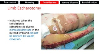 Limb Escharotomy
• Indicated when the
circulation is
compromised due to
increased pressure in the
burned limb and can not
be relieved by simple
elevation.
Assessment Dressing Debridement Wound Closure Rehabilitation
 