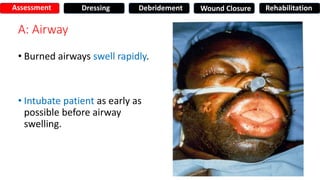 A: Airway
• Burned airways swell rapidly.
• Intubate patient as early as
possible before airway
swelling.
Assessment Dressing Debridement Wound Closure Rehabilitation
 