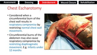 Chest Escharotomy
• Considered when a
circumferential burn of the
chest wall results in
respiratory compromise by
restricting normal chest wall
movement.
• Circumferential burns of the
abdomen may also cause
respiratory compromise by
restricting diaphragmatic
movement. E.g. Infants under
12 months
Assessment Dressing Debridement Wound Closure Rehabilitation
 