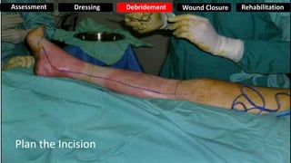 Plan the Incision
Assessment Dressing Debridement Wound Closure Rehabilitation
 