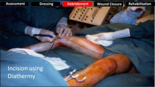 Incision using
Diathermy
Assessment Dressing Debridement Wound Closure Rehabilitation
 