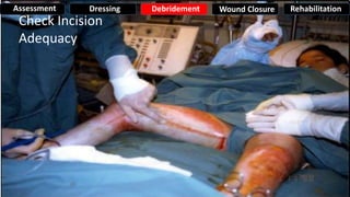 Check Incision
Adequacy
Assessment Dressing Debridement Wound Closure Rehabilitation
 