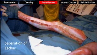 Separation of
Eschar
Assessment Dressing Debridement Wound Closure Rehabilitation
 