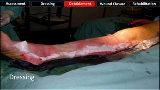 Dressing
Assessment Dressing Debridement Wound Closure Rehabilitation
 
