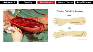 Assessment Dressing Debridement Wound Closure Rehabilitation
 