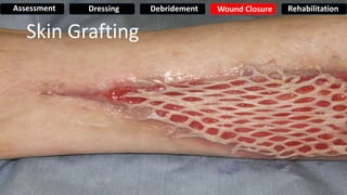 Skin Grafting
Assessment Dressing Debridement Wound Closure Rehabilitation
 