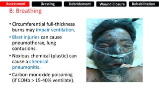 B: Breathing
• Circumferential full-thickness
burns may impair ventilation.
• Blast injuries can cause
pneumothorax, lung
contusions.
• Noxious chemical (plastic) can
cause a chemical
pneumonitis.
• Carbon monoxide poisoning
(if COHb > 15-40% ventilate).
Assessment Dressing Debridement Wound Closure Rehabilitation
 