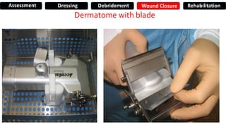 Dermatome with blade
Assessment Dressing Debridement Wound Closure Rehabilitation
 