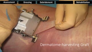 Dermatome-harvesting Graft
Assessment Dressing Debridement Rehabilitation
 