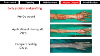 Early excision and grafting
Pre-Op wound
Application of Homograft
Day 3
Complete healing
Day 21
Assessment Dressing Debridement Wound Closure Rehabilitation
 