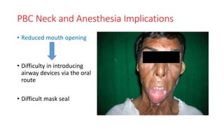 PBC Neck and Anesthesia Implications
• Reduced mouth opening
• Difficulty in introducing
airway devices via the oral
route
• Difficult mask seal
 
