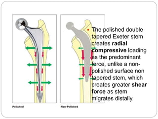 Cont.
 The polished double
tapered Exeter stem
creates radial
compressive loading
as the predominant
force, unlike a non-
polished surface non
tapered stem, which
creates greater shear
force as stem
migrates distally
 