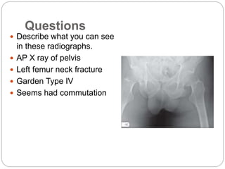 Questions
 Describe what you can see
in these radiographs.
 AP X ray of pelvis
 Left femur neck fracture
 Garden Type IV
 Seems had commutation
 