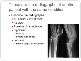 These are the radiographs of another
patient with the same condition
 Describe the radiographs
 AP and lat x ray of wrist
 Ap view
 Posetive ulnar variance
 Significant
 ulnar tilt
 Lunate subsidence
 Lat view
 Palmar carpal displacement
 