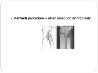  Darrach procedure – ulnar resection arthroplasty
 