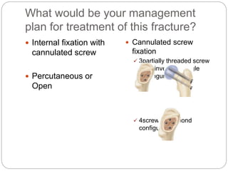 What would be your management
plan for treatment of this fracture?
 Internal fixation with
cannulated screw
 Percutaneous or
Open
 Cannulated screw
fixation
 3partially threaded screw
in an inverted triangle
confinguration
 4screw in diamond
configuration
 