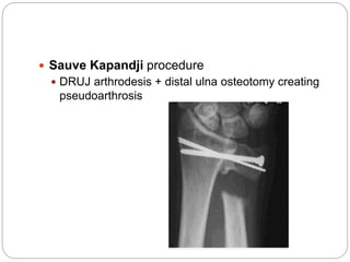  Sauve Kapandji procedure
 DRUJ arthrodesis + distal ulna osteotomy creating
pseudoarthrosis
 