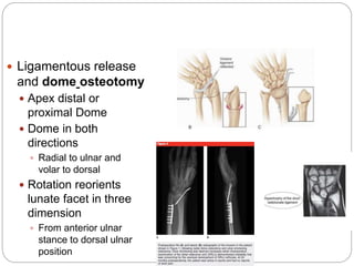  Ligamentous release
and dome osteotomy
 Apex distal or
proximal Dome
 Dome in both
directions
 Radial to ulnar and
volar to dorsal
 Rotation reorients
lunate facet in three
dimension
 From anterior ulnar
stance to dorsal ulnar
position
 