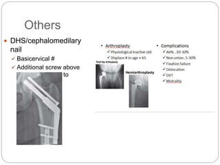 Others
 DHS/cephalomedilary
nail
 Basicervical #
 Additional screw above
sliding hip screw to
prevent rotation
 