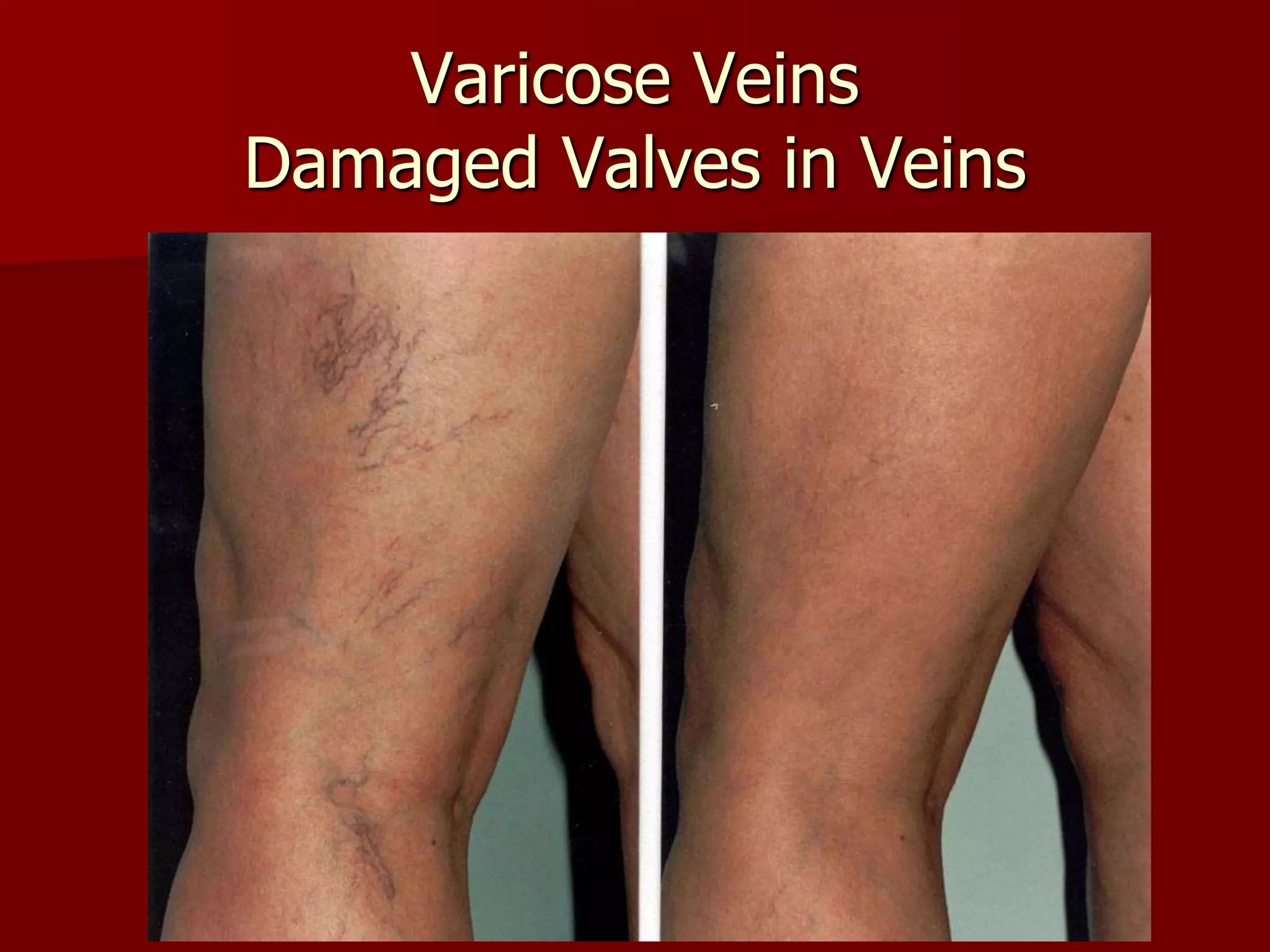 Varicose Veins
Damaged Valves in Veins
 