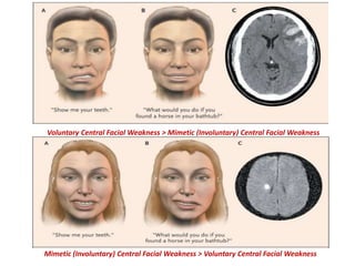 Voluntary Central Facial Weakness > Mimetic (Involuntary) Central Facial Weakness
Mimetic (Involuntary) Central Facial Weakness > Voluntary Central Facial Weakness
 
