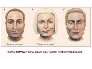 Panel A: UMN type, Panel B: LMN type, Panel C: right hemifacial spasm
 