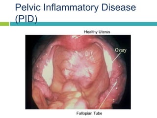 Pelvic Inflammatory Disease
(PID)
Healthy Uterus
Fallopian Tube
 