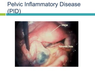 Pelvic Inflammatory Disease
(PID)
 
