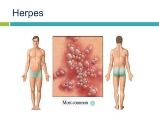 Herpes
 