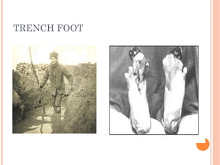 TRENCH FOOT
 