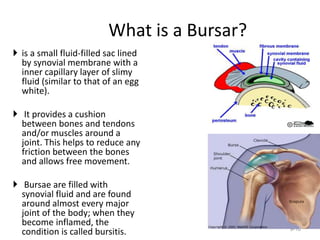 What is a Bursar?
 is a small fluid-filled sac lined
by synovial membrane with a
inner capillary layer of slimy
fluid (similar to that of an egg
white).
 It provides a cushion
between bones and tendons
and/or muscles around a
joint. This helps to reduce any
friction between the bones
and allows free movement.
 Bursae are filled with
synovial fluid and are found
around almost every major
joint of the body; when they
become inflamed, the
condition is called bursitis. 9-16
 