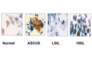 Evidence Based Guide of Screening for Prevention of Cervical Cancer | PPT
