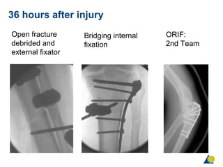 Debrided Principles of fracture management | PPT