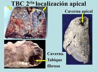 TBC 2ria localización apical
Caverna apical
Caverna.
Tabique
fibroso
 